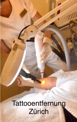 Tattoo Entfernung Volketswil Zürich