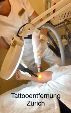 Tattooentfernung Zürich